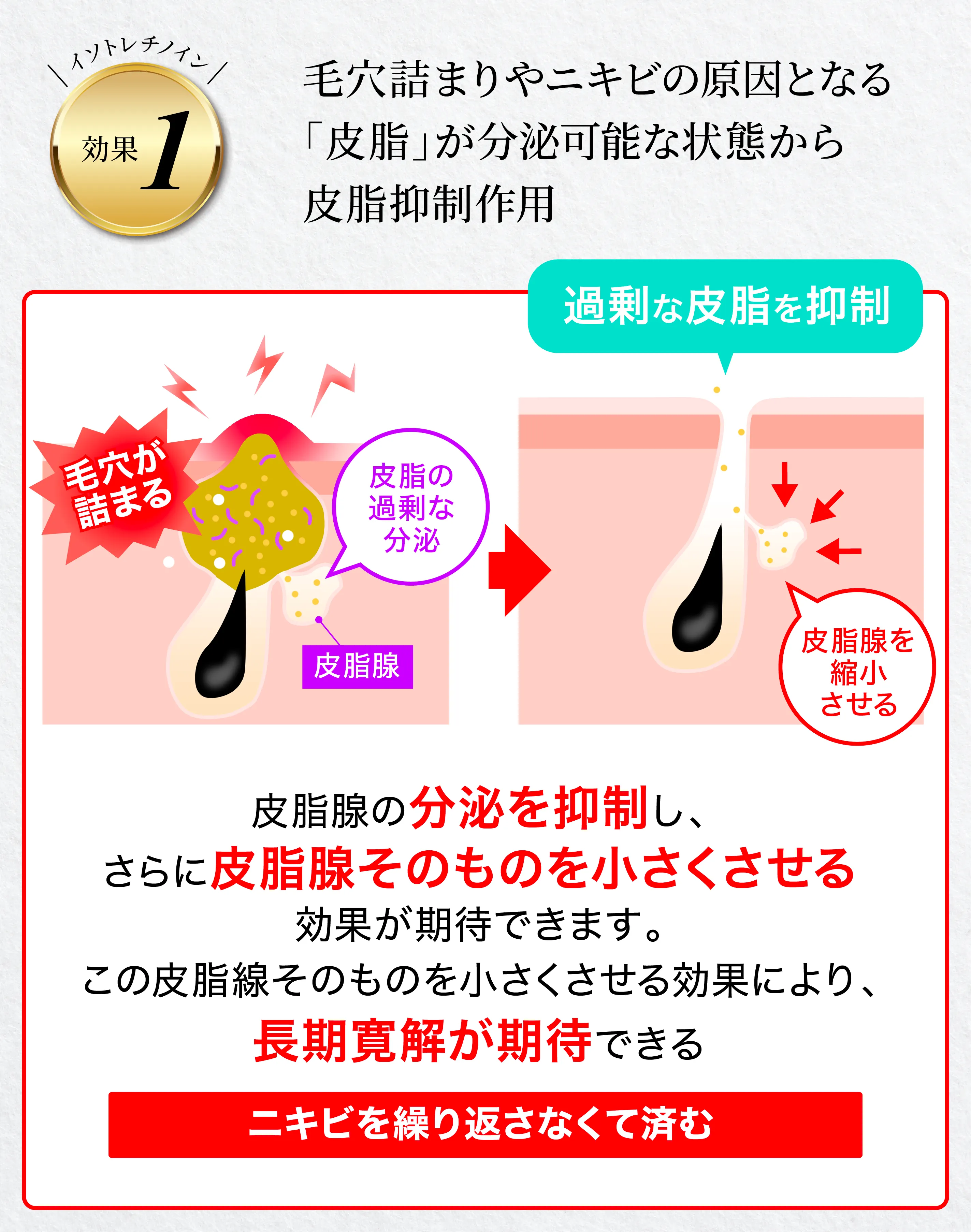イソトレチノインの効果①皮脂抑制作用
