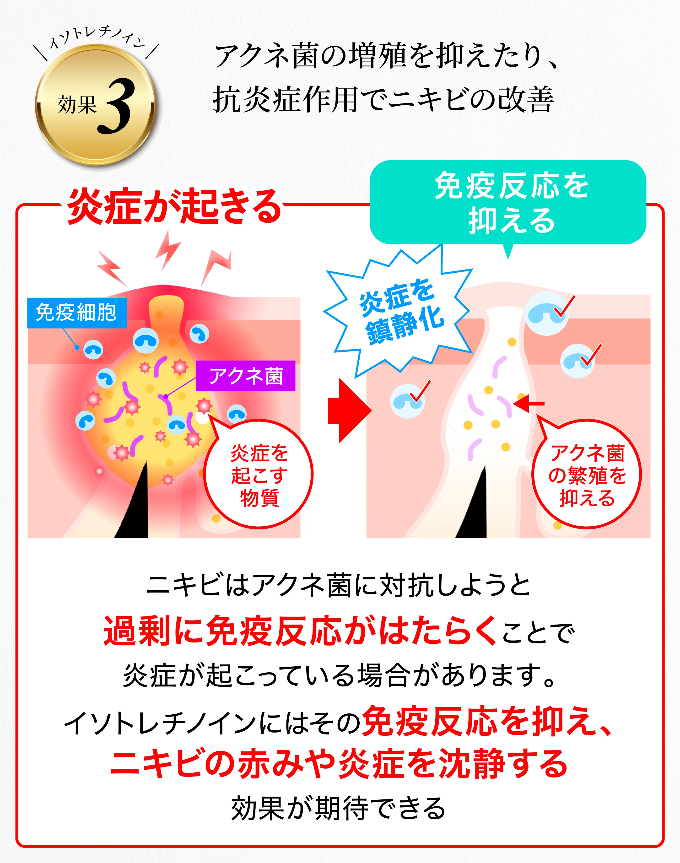 イソトレチノインの効果③抗炎症作用＆アクネ菌の増殖を防ぐ